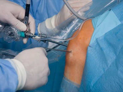 Arthroscopy