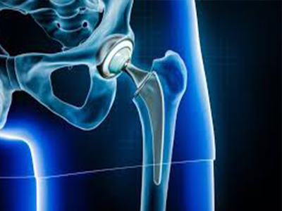 Arthroplasty